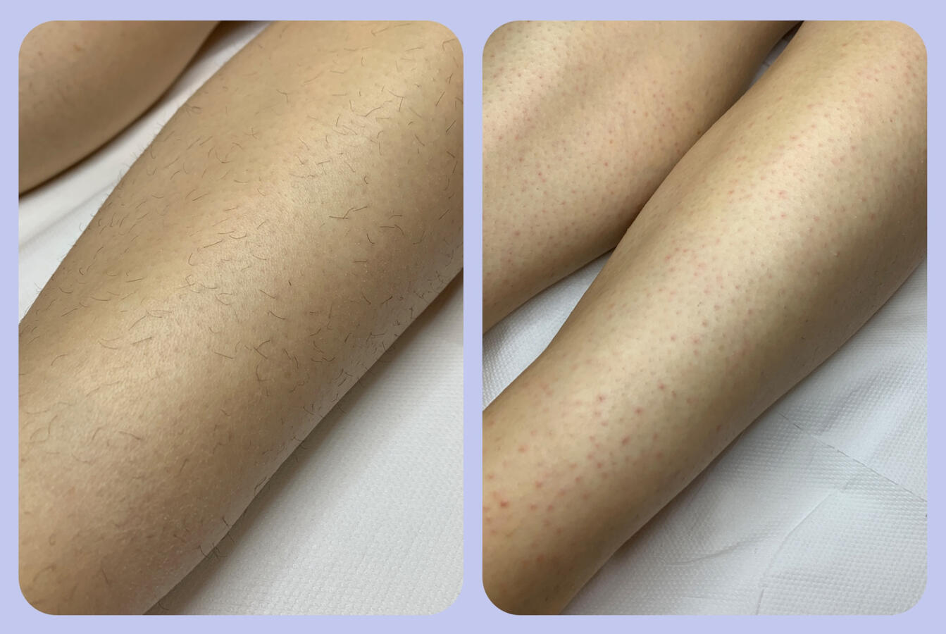 Zabieg depilacji cukrowej nóg – efekt po usunięciu owłosienia w gabinecie LuxeSkin w Toruniu