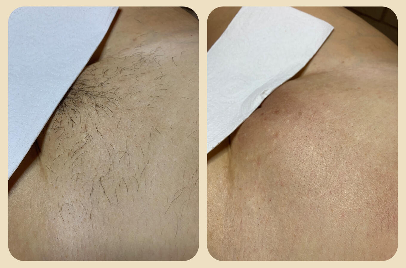 Depilacja głębokiego bikini pastą cukrową – efekt zabiegu w gabinecie LuxeSkin w Toruniu