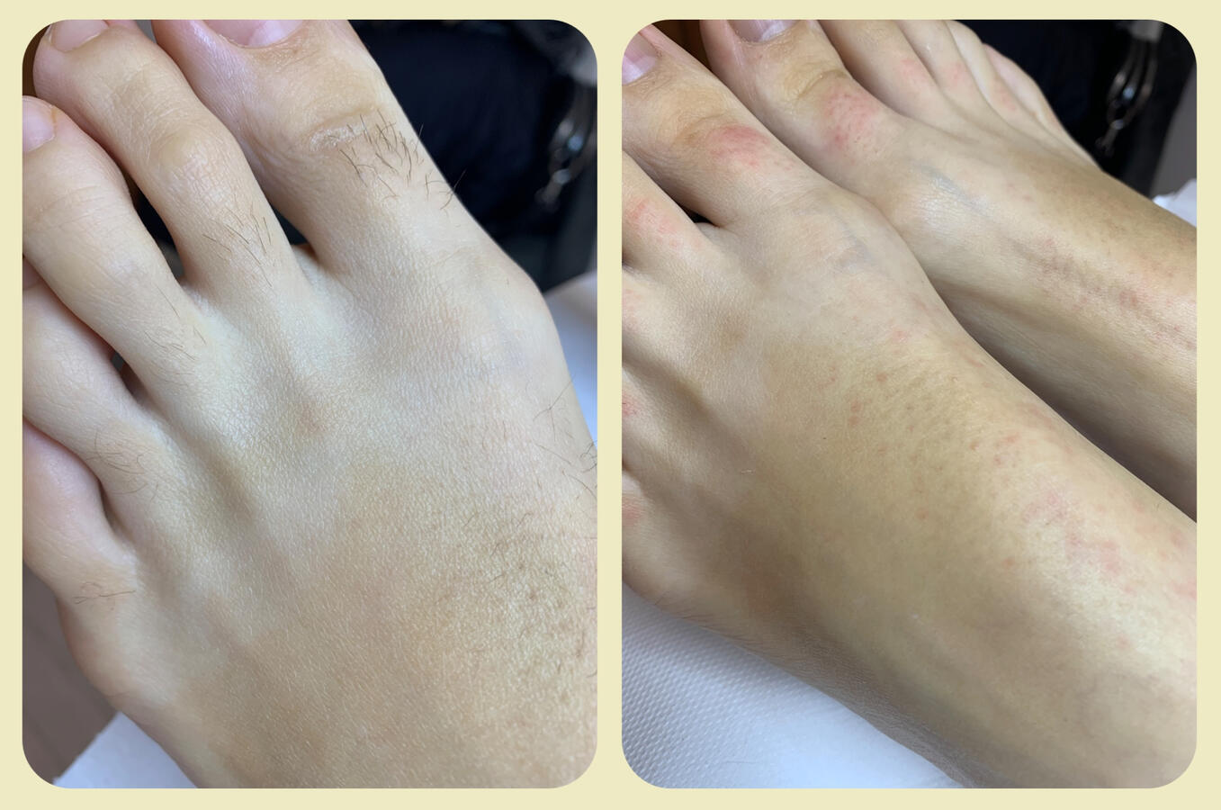 Depilacja pastą cukrową stóp i palców – efekt po zabiegu w gabinecie LuxeSkin w Toruniu