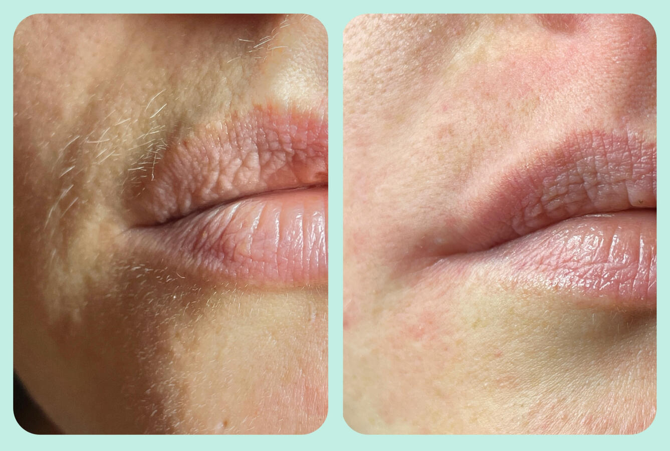 Depilacja wąsika pastą cukrową w gabinecie LuxeSkin w Toruniu – naturalna metoda dla wrażliwej skóry