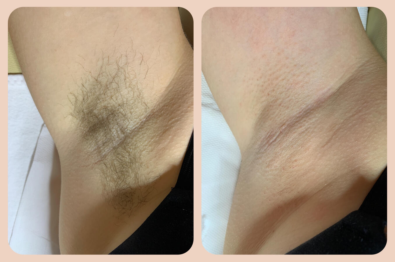 Depilacja pach pastą cukrową w gabinecie LuxeSkin – efekt po zabiegu